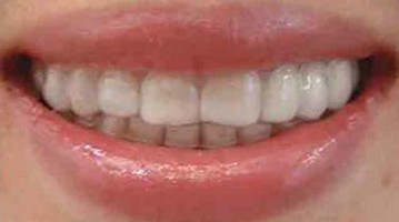 隐形牙套,看不见得牙套,看得见的美丽